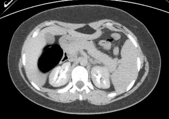 File:Acute unilateral nonhemorrhagic adrenal infarction (Radiopaedia 67560-76957 Axial renal excretory phase 40).jpg