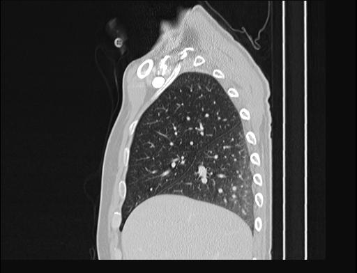 Addison disease (Radiopaedia 49318-54412 Sagittal lung window 48).jpg
