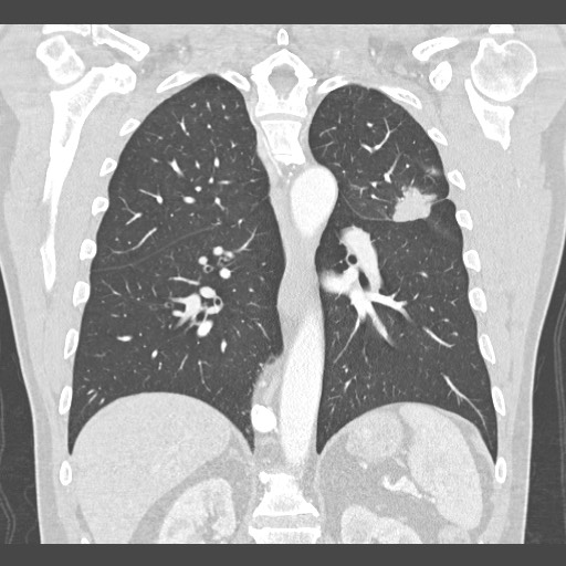 Adenocarcinoma of the lung (Radiopaedia 59871-67325 Coronal lung window 39).jpg