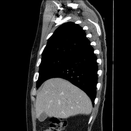 Adenocarcinoma of the lung (Radiopaedia 59871-67325 Sagittal C+ arterial phase 18).jpg