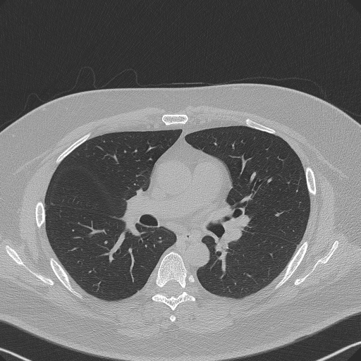 File:Adenoid cystic carcinoma of the trachea (Radiopaedia 49042-54137 Axial lung window 161).jpg