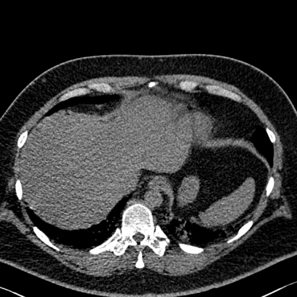 File:Adenoid cystic carcinoma of the trachea (Radiopaedia 49042-54137 Axial non-contrast 290).jpg