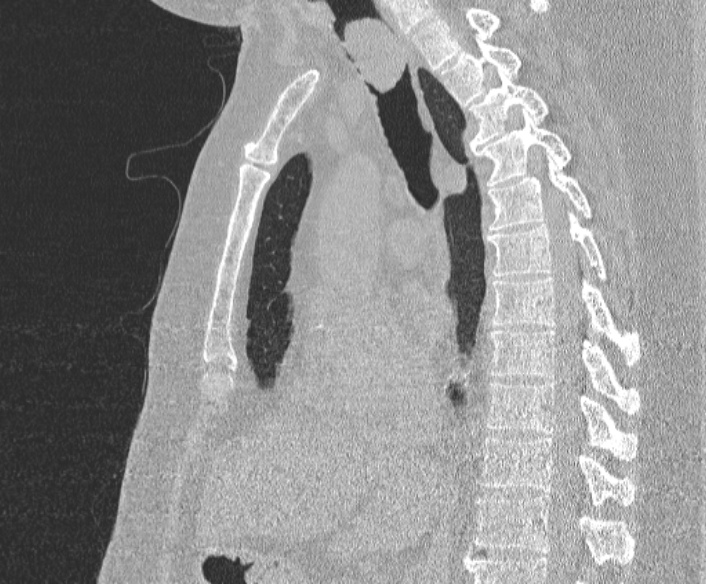 Adenoid cystic carcinoma of the trachea (Radiopaedia 49042-54137 Sagittal lung window 228).jpg