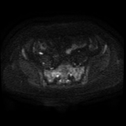 File:Adenoma malignum of cervix (Radiopaedia 66441-75705 Axial DWI 77).jpg