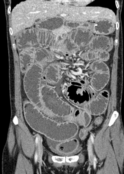Adhesional small bowel obstruction (Radiopaedia 48397-53305 Coronal C+ portal venous phase 127).jpg