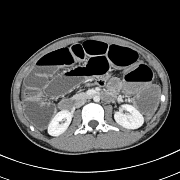 Adhesional small bowel obstruction (Radiopaedia 52107-57980 Axial C+ portal venous phase 49).jpg