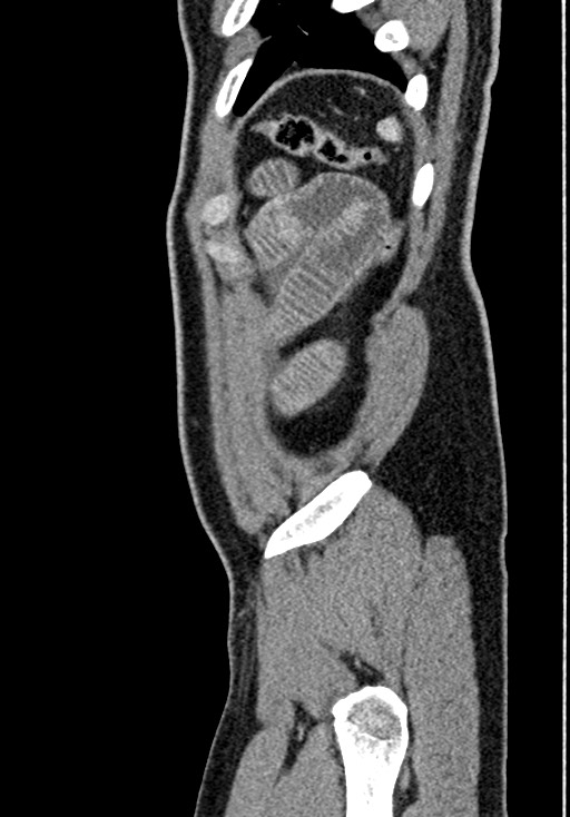 Adhesional small bowel obstruction (Radiopaedia 58900-66131 Sagittal C+ portal venous phase 227).jpg
