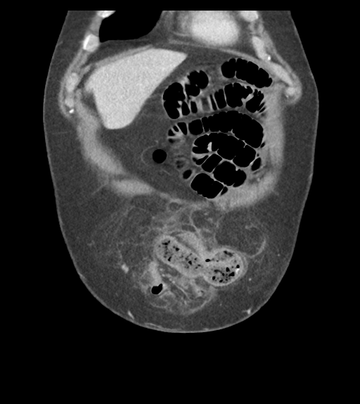File:Adhesions within abdominal wall hernia (Radiopaedia 58283-65394 Coronal C+ portal venous phase 15).png
