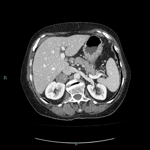 File:Adrenal collision tumor (ACT) (Radiopaedia 48462-53379 Axial C+ portal venous phase 15).jpg