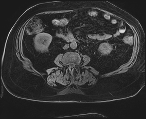 Adrenal cortical carcinoma (Radiopaedia 64017-72770 Axial T1 C+ fat sat 38).jpg