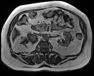 File:Adrenal cortical carcinoma (Radiopaedia 64017-72770 Axial T1 out-of-phase 37).jpg