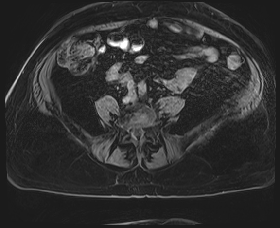 Adrenal cortical carcinoma (Radiopaedia 64017-72770 H 57).jpg