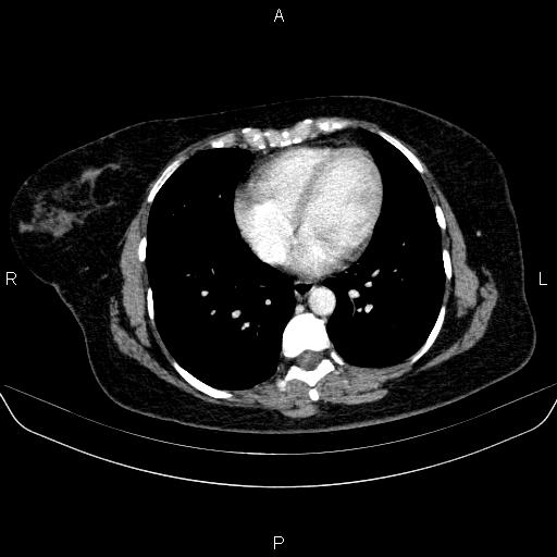 Adrenal cortical carcinoma (Radiopaedia 84882-100379 Axial C+ portal venous phase 1).jpg