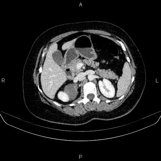 Adrenal cortical carcinoma (Radiopaedia 84882-100379 Axial C+ portal venous phase 30).jpg