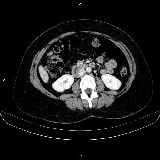 File:Adrenal cortical carcinoma (Radiopaedia 84882-100379 Axial C+ portal venous phase 44).jpg
