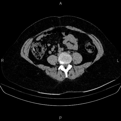 File:Adrenal cortical carcinoma (Radiopaedia 84882-100379 Axial non-contrast 58).jpg