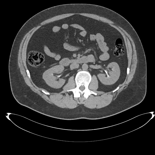 File:Adrenal cyst (Radiopaedia 45625-49778 Axial non-contrast 50).png