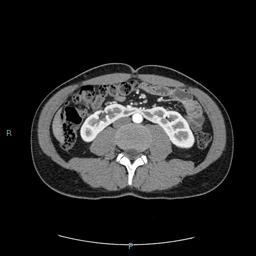 Adrenal cystic lymphangioma (Radiopaedia 83161-97534 Axial C+ arterial phase 51).jpg