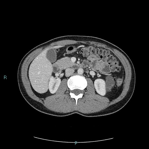 Adrenal cystic lymphangioma (Radiopaedia 83161-97534 Axial C+ portal venous phase 39).jpg