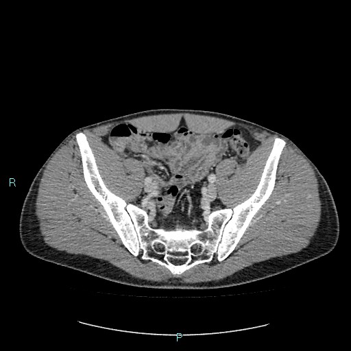 Adrenal cystic lymphangioma (Radiopaedia 83161-97534 Axial C+ portal venous phase 78).jpg