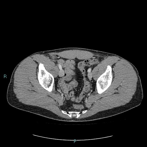 Adrenal cystic lymphangioma (Radiopaedia 83161-97534 Axial C+ portal venous phase 86).jpg