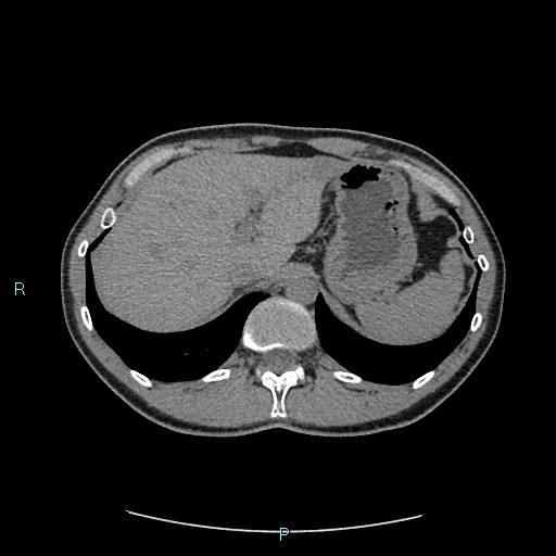 Adrenal cystic lymphangioma (Radiopaedia 83161-97534 Axial non-contrast 23).jpg