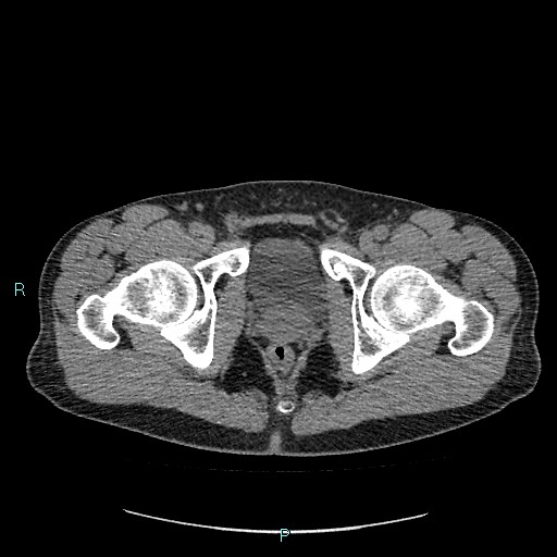 Adrenal cystic lymphangioma (Radiopaedia 83161-97534 Axial non-contrast 97).jpg