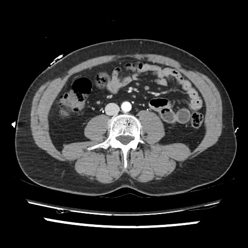 Adrenal gland trauma (Radiopaedia 81351-95078 Axial Dual bolus trauma C+ 84).jpg