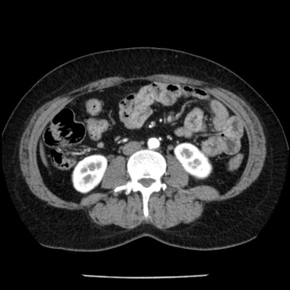 Adrenal myelolipoma (Radiopaedia 43401-46759 Axial C+ arterial phase 55).jpg