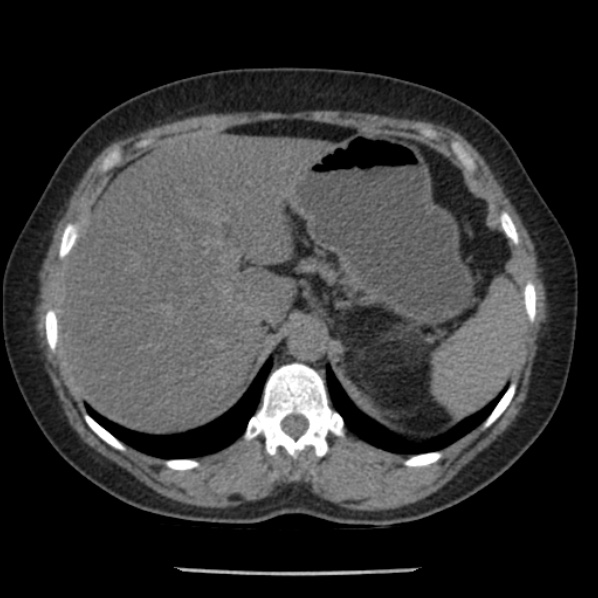 Adrenal myelolipoma (Radiopaedia 43401-46759 Axial non-contrast 20).jpg