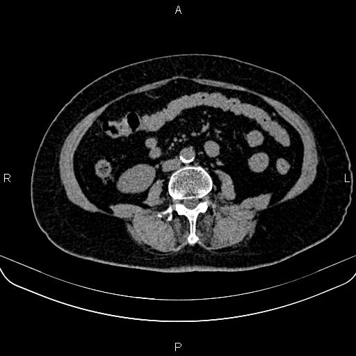 Adrenal myelolipoma (Radiopaedia 82742-96986 Axial non-contrast 91).jpg