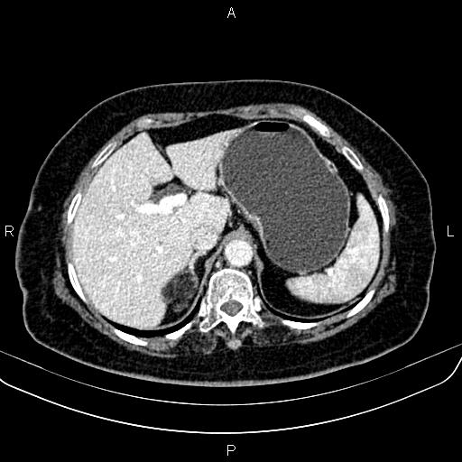 Adrenal myelolipoma (Radiopaedia 82742-96986 Axial renal cortical phase 40).jpg