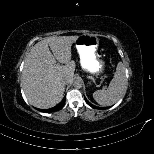 File:Adrenal myelolipoma (Radiopaedia 84319-99617 Axial With oral contrast 51).jpg