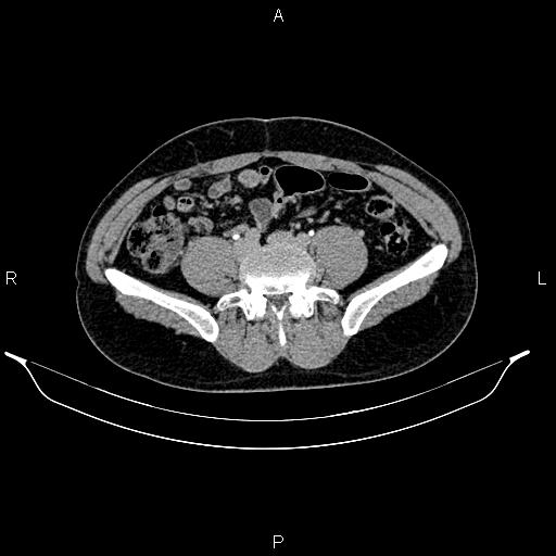 Adrenal myelolipoma (Radiopaedia 87794-104246 Axial renal excretory phase 68).jpg