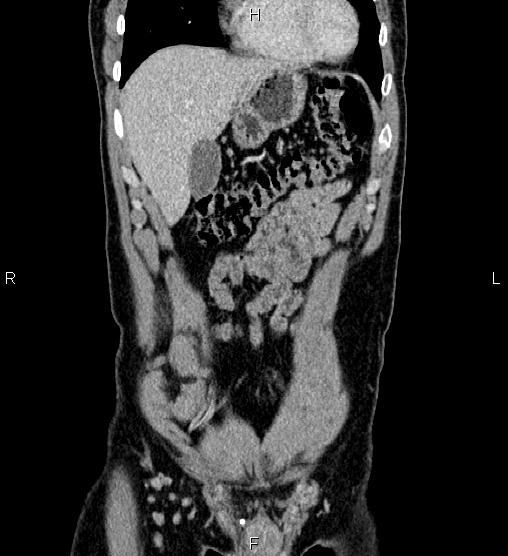 Adrenal myelolipoma (Radiopaedia 87794-104246 Coronal renal cortical phase 12).jpg