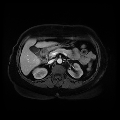 Adrenal myelolipoma - MRI (Radiopaedia 83249-97646 T1 fat sat arterial phase 38).jpg