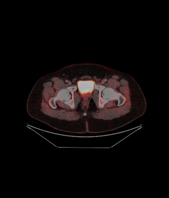 Adrenocortical carcinoma (Radiopaedia 80134-93440 ِAxial 251).jpg