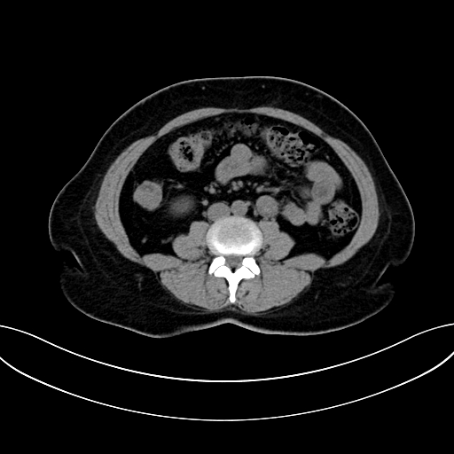 Adrenocortical carcinoma (Radiopaedia 87281-103569 Axial non-contrast 50).jpg