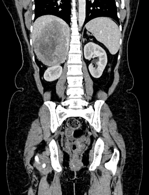 Adrenocortical carcinoma (Radiopaedia 87281-103569 Coronal C+ portal venous phase 86).jpg