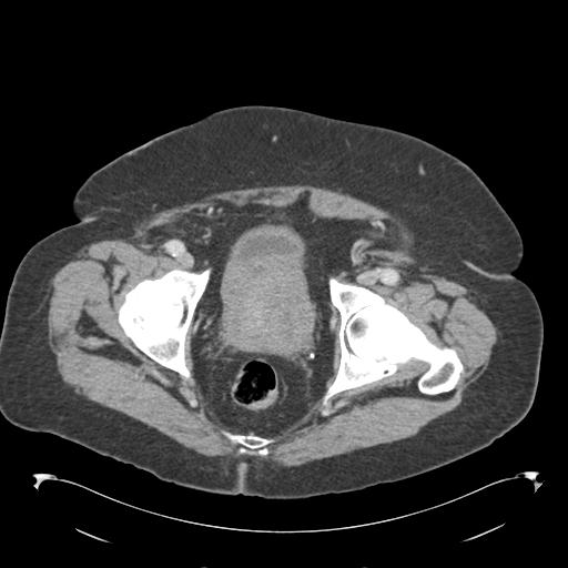 Adult ileal intussusception with secondary obstruction (Radiopaedia 30395-31051 Axial C+ portal venous phase 72).jpg
