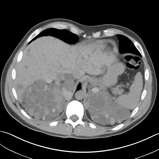 File:Adult polycystic kidney disease (Radiopaedia 47866-52626 Axial non-contrast 12).png