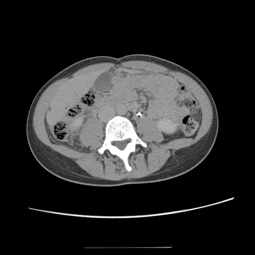 Adult polycystic kidney disease (Radiopaedia 48845-53876 Axial renal excretory phase 53).jpg