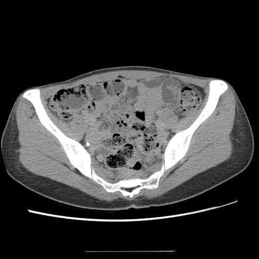 Adult polycystic kidney disease (Radiopaedia 48845-53876 Axial renal excretory phase 76).jpg
