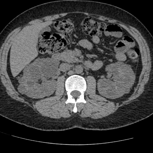 Adult polycystic kidney disease (Radiopaedia 59075-66368 Axial non-contrast 32).jpg