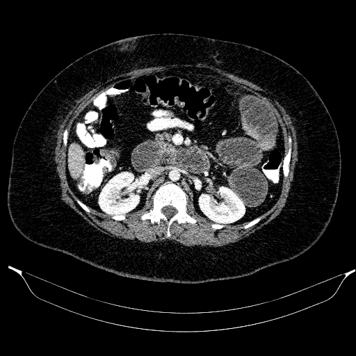Afferent loop syndrome - secondary to incarcerated trocar site hernia (Radiopaedia 82959-97305 Axial C+ portal venous phase 98).jpg