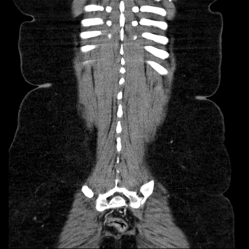 File:Afferent loop syndrome - secondary to incarcerated trocar site hernia (Radiopaedia 82959-97305 Coronal C+ portal venous phase 125).jpg