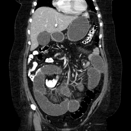 File:Afferent loop syndrome - secondary to incarcerated trocar site hernia (Radiopaedia 82959-97305 Coronal C+ portal venous phase 61).jpg