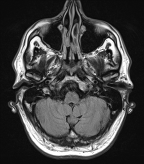 File:Alzheimer's disease- with Gerstmann syndrome and dressing apraxia (Radiopaedia 54882-61150 Axial FLAIR 4).png