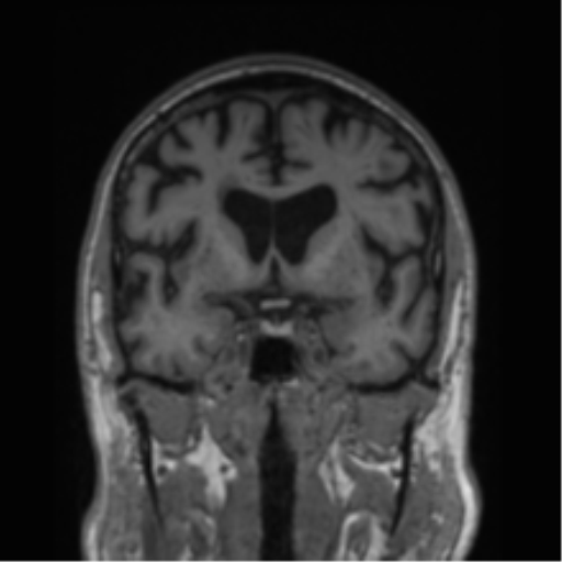 Alzheimer's disease- with Gerstmann syndrome and dressing apraxia (Radiopaedia 54882-61150 Coronal T1 55).png