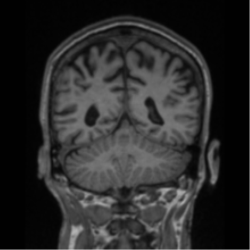 File:Alzheimer's disease- with apraxia (Radiopaedia 54763-61011 Coronal T1 33).png
